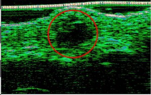 DUB cutis brochure07