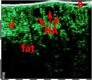 HFUS Plastic Surgery applications 11
